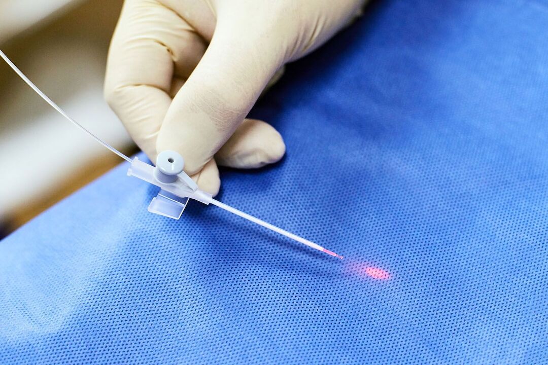 Dispositivo transrectal para el tratamiento de la próstata. 