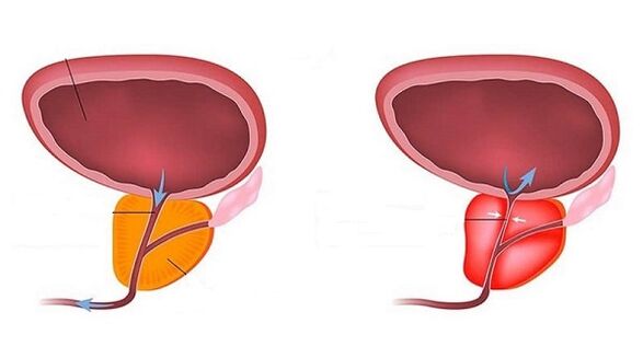 Prostata sana e inflamada con prostatitis