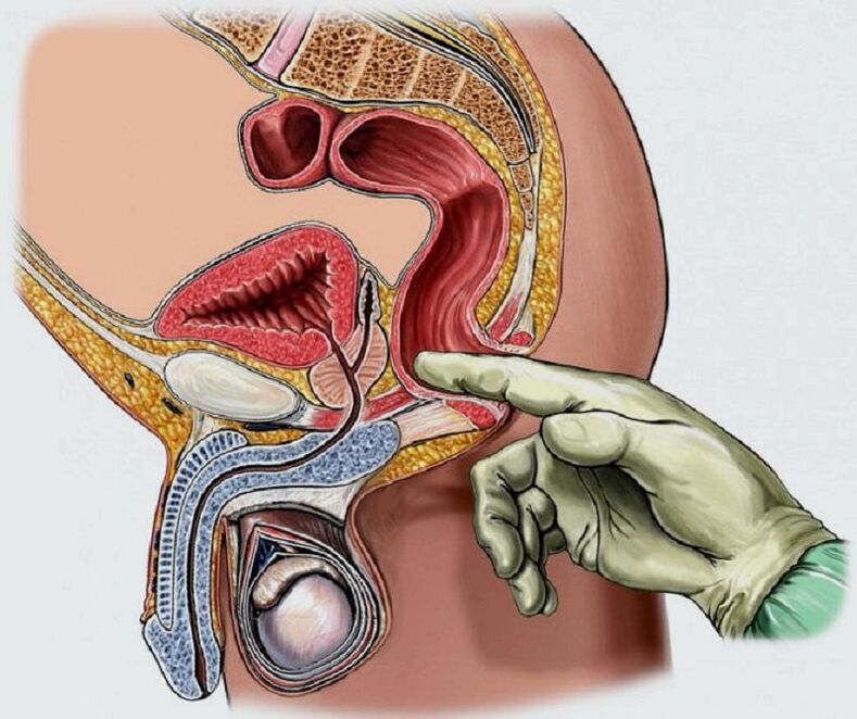 Masaje de próstata para la prostatitis.
